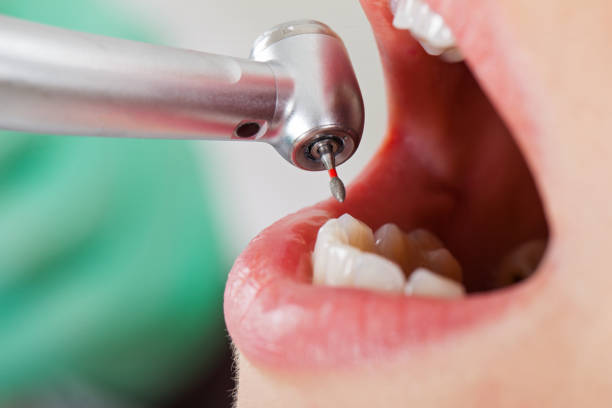 Best Emergency Tooth Extraction in Churubusco, IN